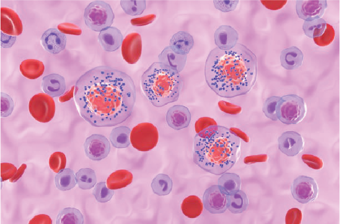 CHMP issued positive opinion for sacituzumab govitecan as first-line monotherapy in metastatic triple-negative breast cancer